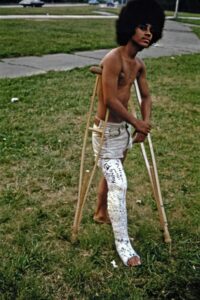 a shirtless young man with his full leg in an old fashioned plaster cast, he is using under arm crutches for support